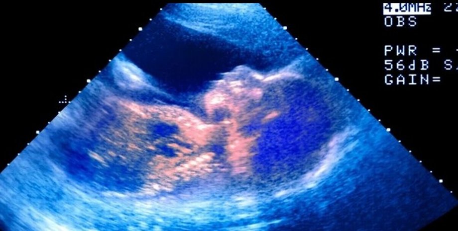 Плод, ребенок, ультразвук, утроба