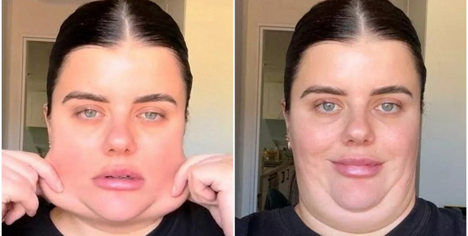 Схуднення, друге підборіддя, ліпосакція, краса, зовнішність, пластична операція, Анжела Хатчінсон з Великої Британії, фото