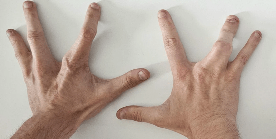 Мужчина родился с четырьмя пальцами на руках, четыре пальца на руке, генетическая лотерея, операция на руке, нет среднего пальца