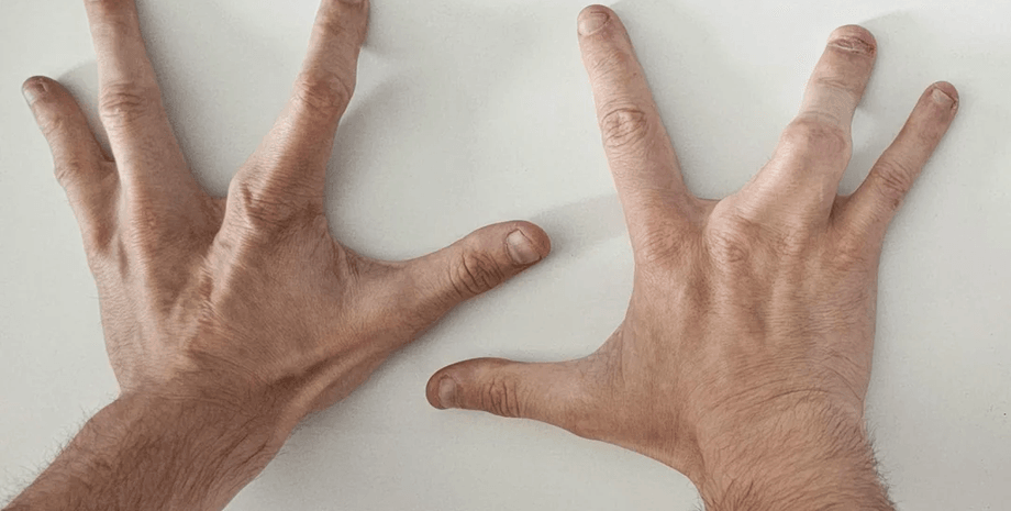 Мужчина родился с четырьмя пальцами на руках, четыре пальца на руке, генетическая лотерея, операция на руке, нет среднего пальца