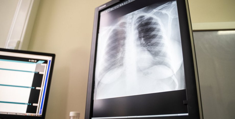рентген, легкие, коронавирус