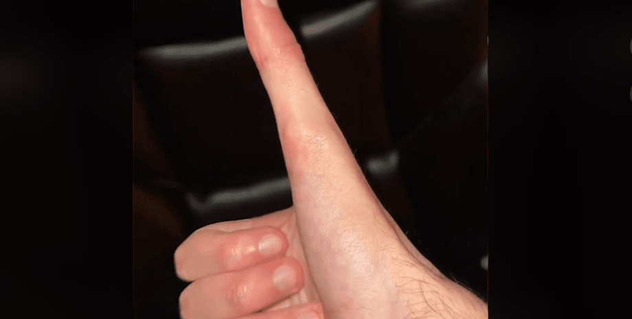 Джейкоб Піна, великий палець