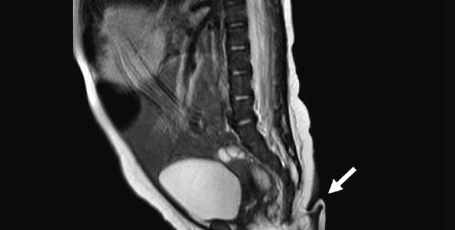 хвіст, людський хвіст