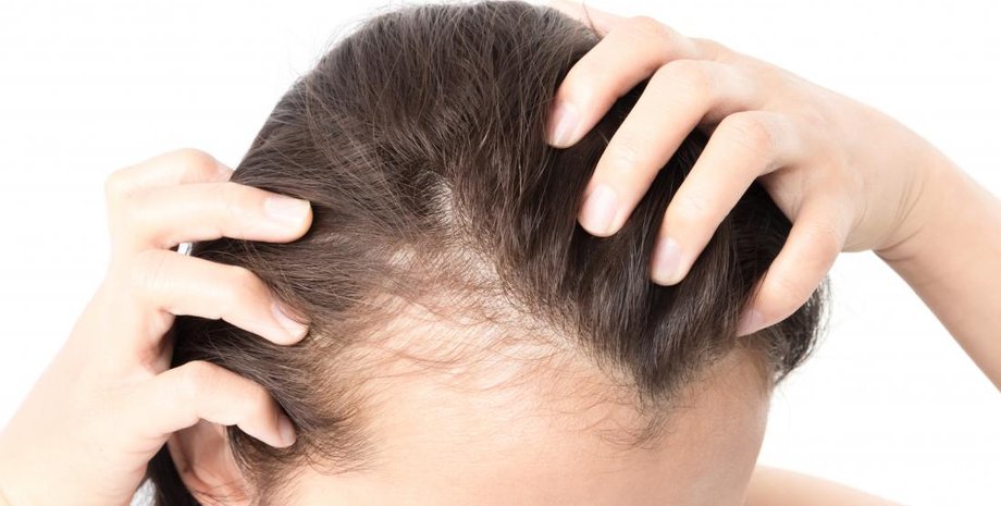 облысение, человек, волосы, фото