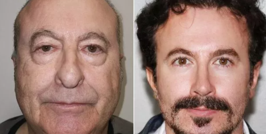 Пластическая хирургия в Турции, операция, изменение внешности, до и после ринопластики, пересадка волос