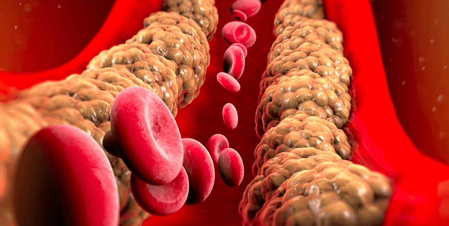 сосуд, кровь, бляшка, холестерин, эритроциты