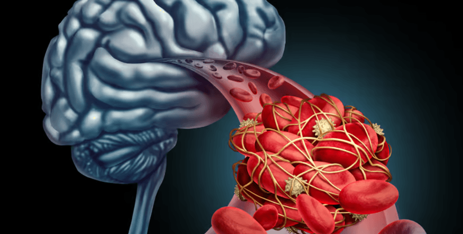 кровь, кровяной сгусток, мозг, сосуд, эритроциты