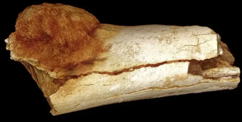 древние люди, рак, болезнь, первый случай рака, исследование, археология, раскопки, история