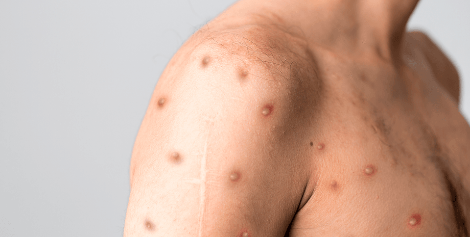 Обезьянья оспа, обезьянья оспа в Польше, эпидемия оспы обезьян