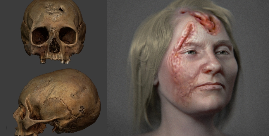 реконструкція обличчя, жінка з сифілісом