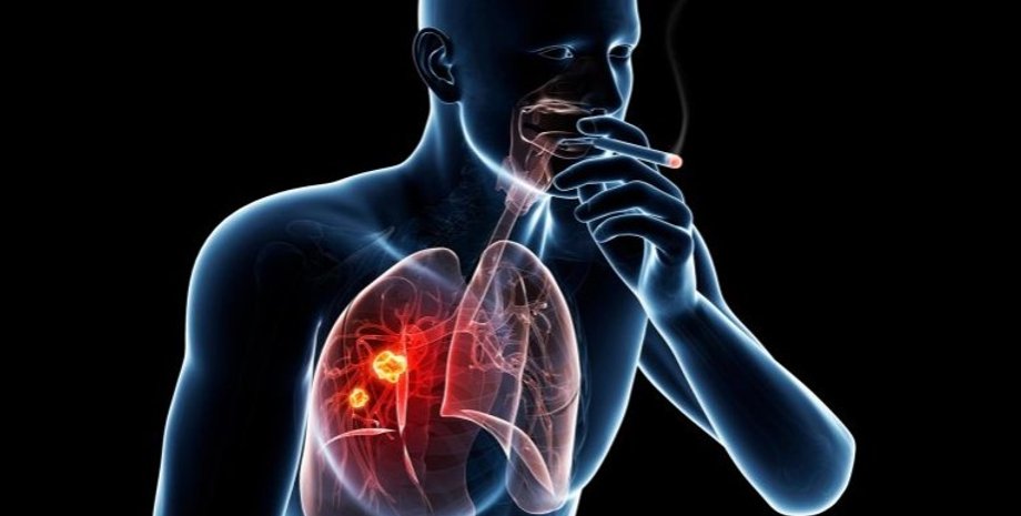 Куріння, рак легенів