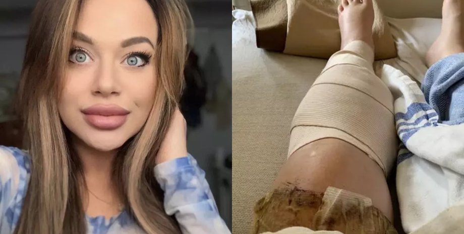 Девушка, женщина, нога, больница, операция