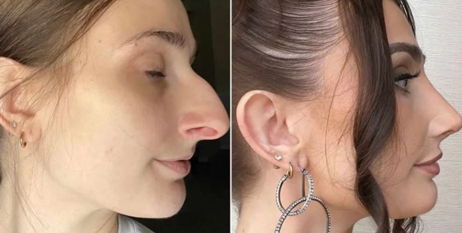 Операция на носу, изменение во внешности, изменения, красота, трансформация, эксперимент, фото, развод, личная жизнь