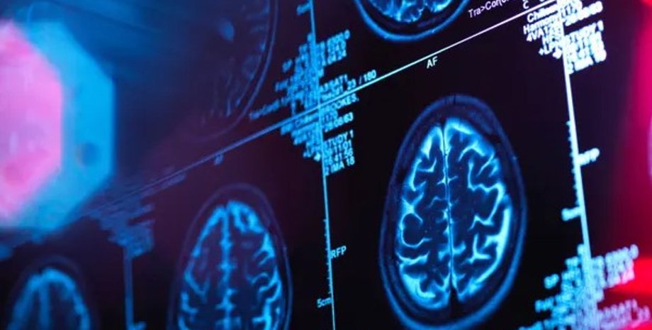 череп, міг, зв'язок між черепом і мозком