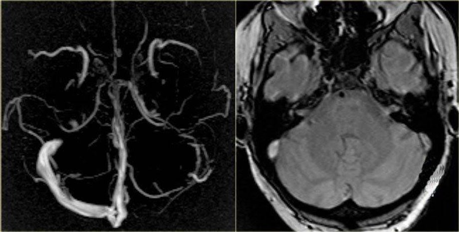 AstraZeneca, вакцина, вакцинация, Украина, препарат, коронавирус, приостанавливают вакцинацию, Канада