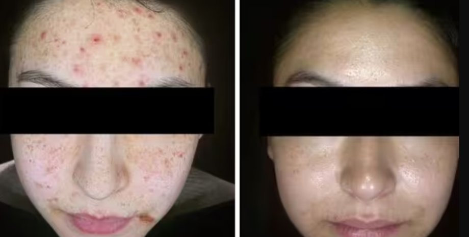 акне, прыщи