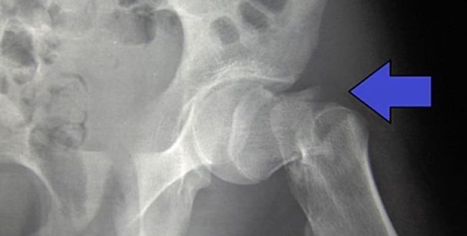 перелом, бедро, шейка бедра, рентген