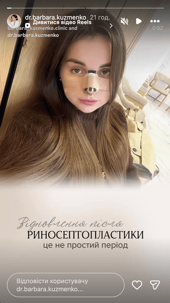 Барбара Кузьменко зробила риносептопластику