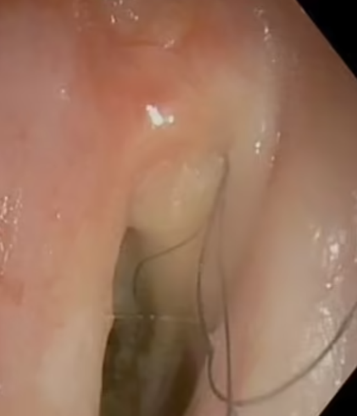 Волосся росте в горлі затятого курця, дивні діагнози, захворювання внаслідок куріння, розлади, курйози, фото, Австрія