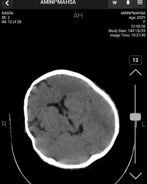комп'ютерна томографія, мозок, Аміні