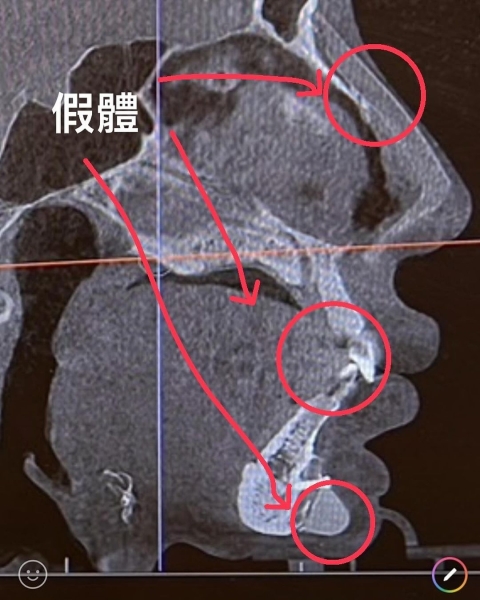 Фан Ціюань з Тайваню Фан Ціюань з Тайваню, пластична операція, рентген в аеропорту, косметичні процедури, зовнішність, краса, фото, курйози