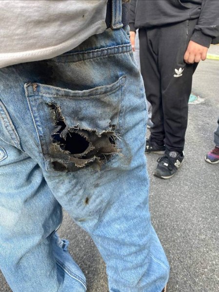 подросток шахед ожоги, взорвалась деталь шахеда