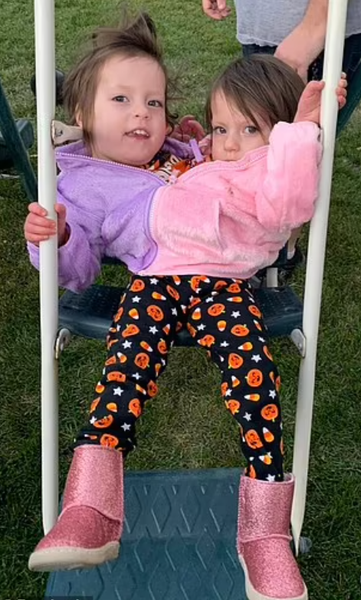 Біографія сіамських близнючок Келлі та Картер із США, унікальні діти, аномалії, операція, курйози, дивовижні історії, фото