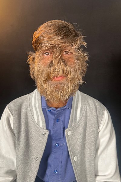 подросток с синдромом оборотня