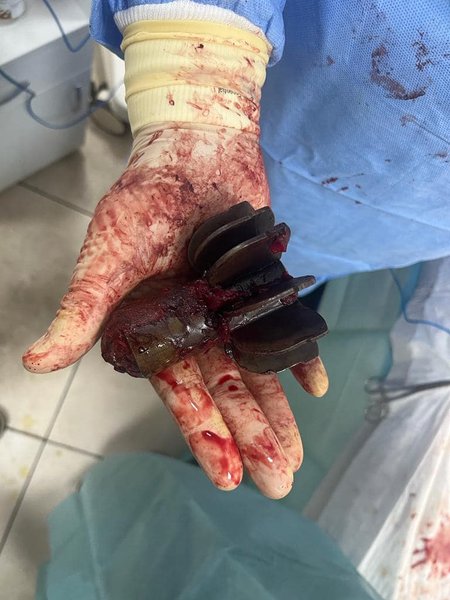 хвостовик мины, операция, военные медики, ВСУ, война РФ против Украины, российское вторжение