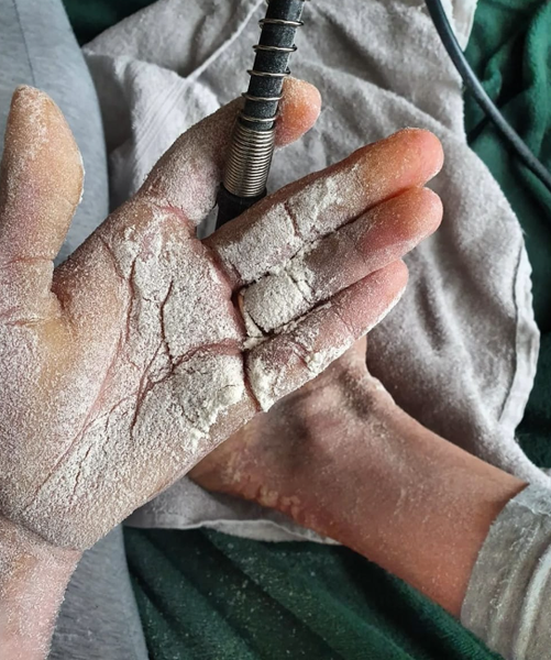 Мария Жампачева, расстройство, странный диагноз, генетическое заболевание, проблемы с кожей, фото, Чехия