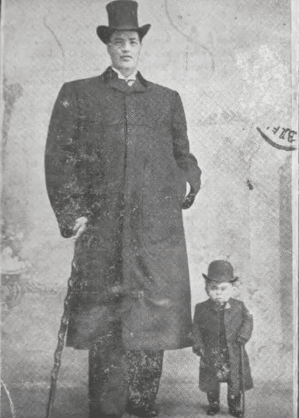 Карлик, висока людина, гігант, велетень, рідкісне захворювання, пухлина, гормон росту, диво медицини, Адам Райнер