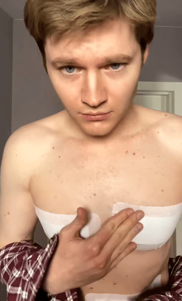 гинекомастия