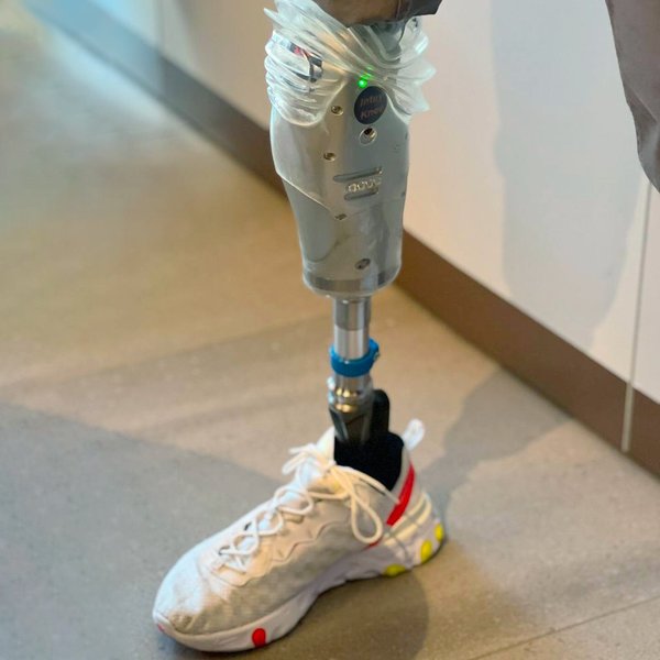 протез, протезирование, инвалидность