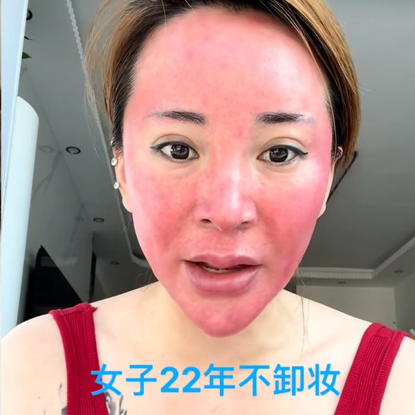 Гао, красное лицо, косметология, макияж