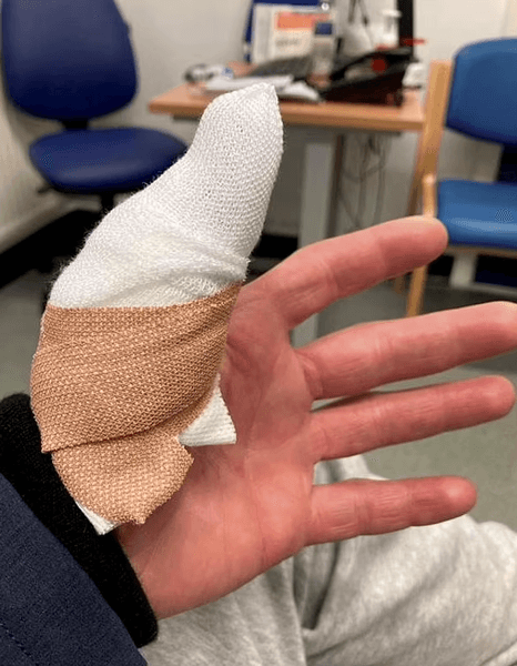 Мужчину белка укусила за руку