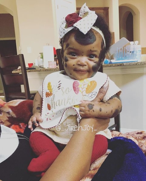 девочка с пятнами на лице, невус