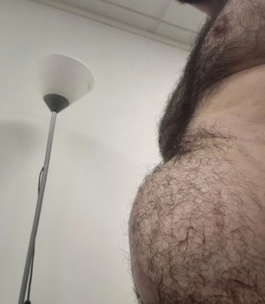 Чоловік з грижею має вигляд, наче на 7 місяці вагітності, Пол Мілхем, Велика Британія, операція