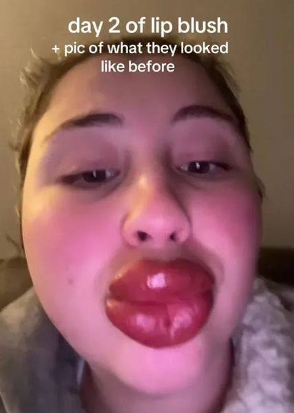 Женщина решила увеличить губы в салоне красоты, но процедура пошла не по плану, курьезы, внешность