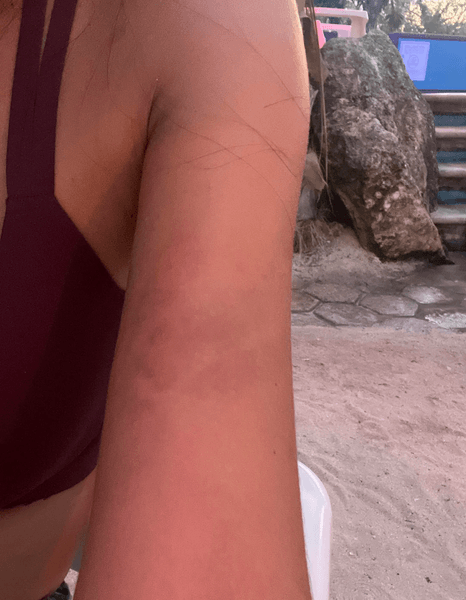 Укус комара, комар, насекомое, курьезы, цвет кожи после укуса насекомого, неизвестное насекомое,