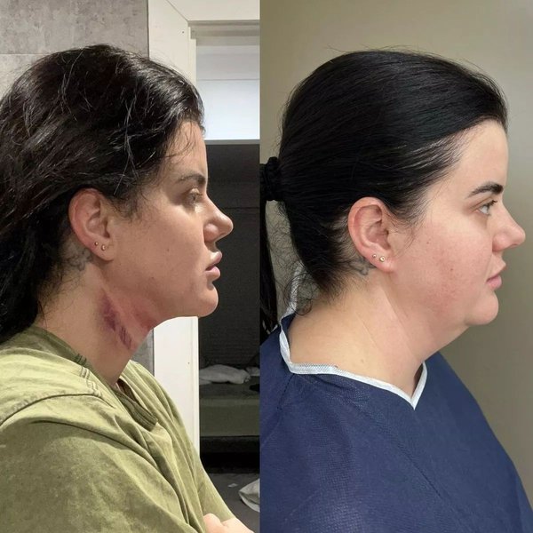 Схуднення, друге підборіддя, ліпосакція, краса, зовнішність, пластична операція, Анжела Хатчінсон з Великої Британії, фото