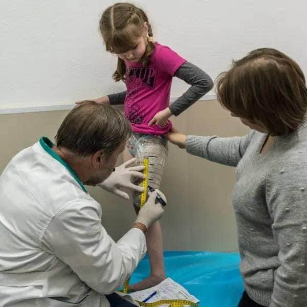 протезирование ноги, протез ноги, протезирование, детский протез, ампутировали ногу, ампутация, охматдит, протез, протезирование ребенка