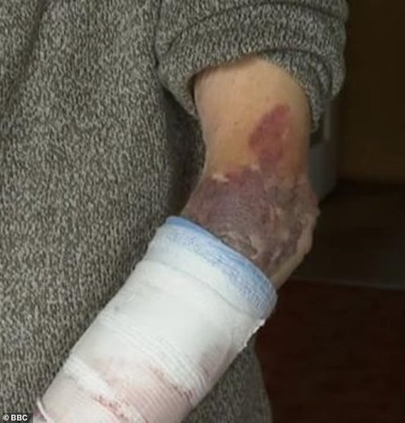 Следы насилия на предплечье 102-летнего пенсионера