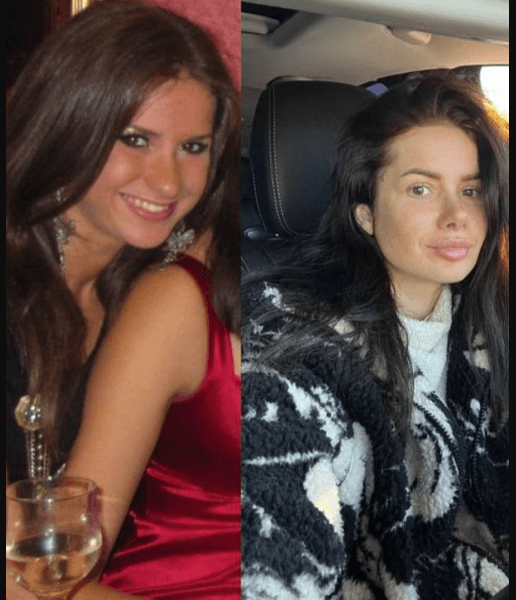 Аліна Шаманська до і після пластики