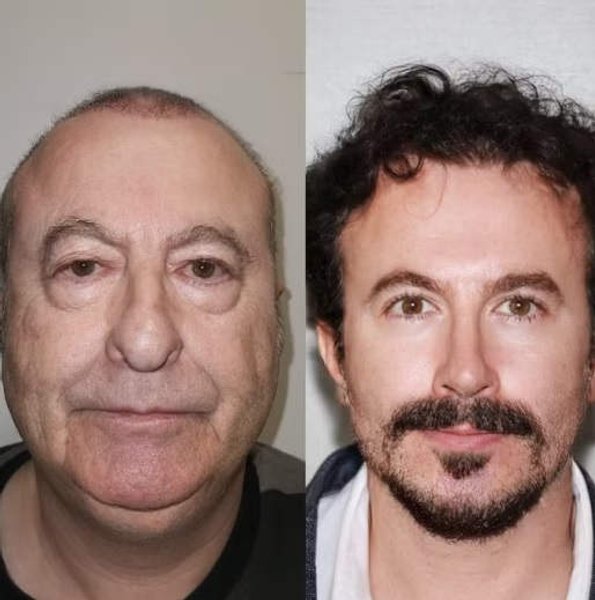 Пластическая операция, операция на лице, фото до и после, клиника, ринопластика, хирург, доктор, внешний вид,