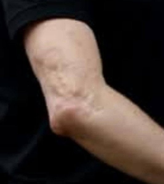 На згадку про порятунок Буданова у нього лишився шрам на руці