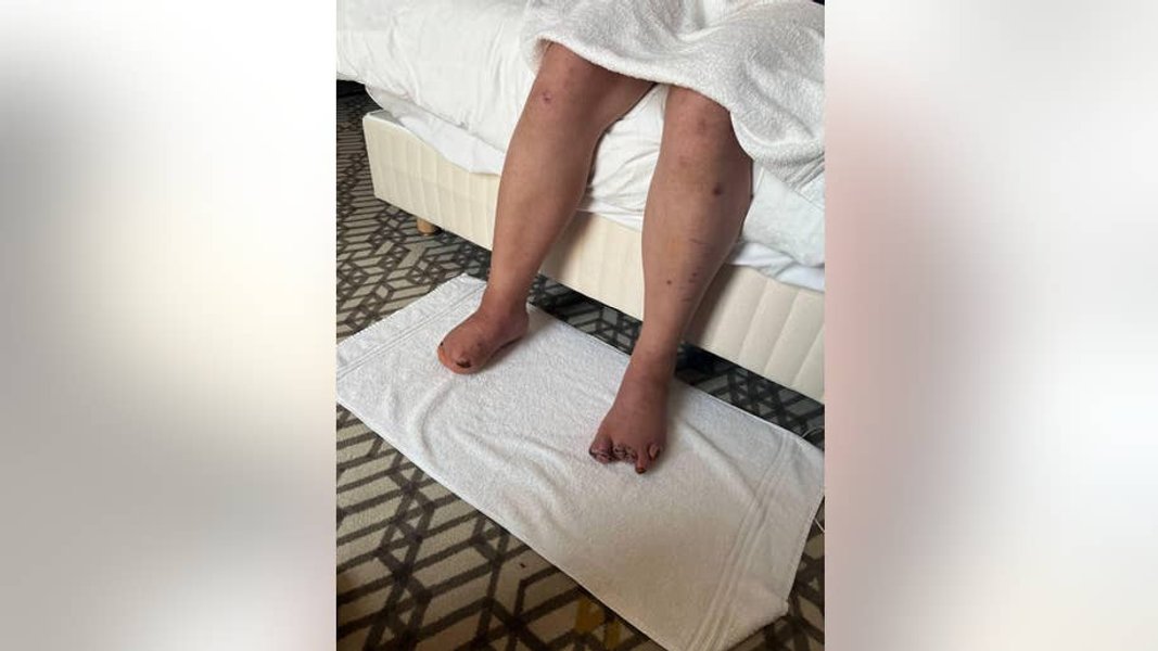 обмороженные ноги, отрезанные пальцы, пытки российских солдат, Преподаватель и бизнесмен Олега Москаленко рассказал о пытках российских солдат. Преподаватель и бизнесмен Олега Москаленко рассказал о пытках российских солдат.