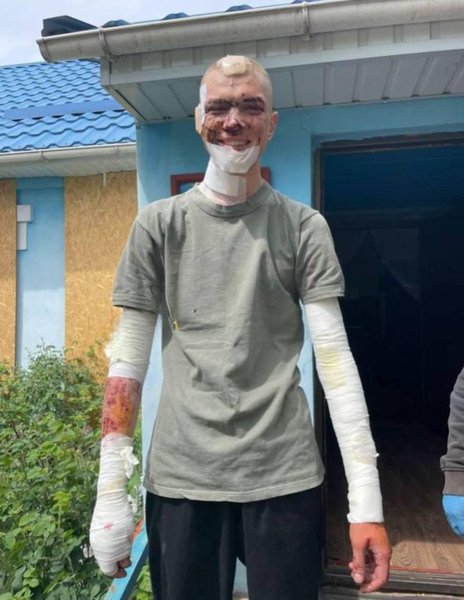 Виживший після влучання Ланцета