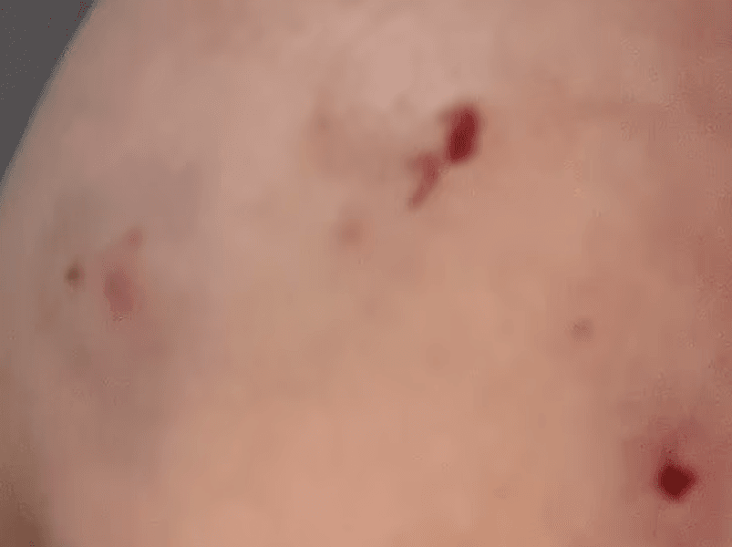 укусы белки Полоски