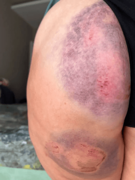 укус, синець