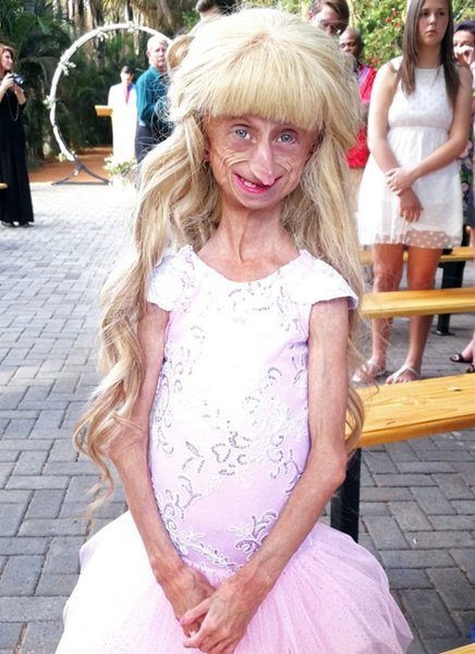 Девочка с редким заболеванием, Беандри Буйсен, редкий синдром, девушка старела в восемь раз быстрее, синдромом Хатчинсона-Гилфорда